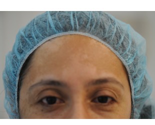 treating melasma after pregnancy | Skin and Laser Surgery Center of New England
