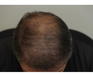 PRP Hair Loss Treatment