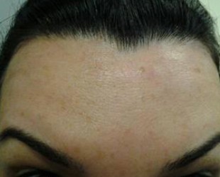 after botox | Skin and Laser Surgery Center of New England