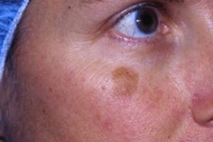 laser surgery for moles on face | Skin and Laser Surgery Center of New England