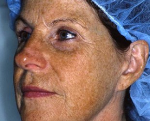 ageless skin rejuvenation | Skin and Laser Surgery Center of New England