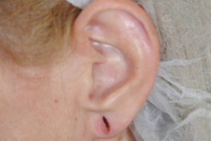 split earlobe repair | Skin and Laser Surgery Center of New England