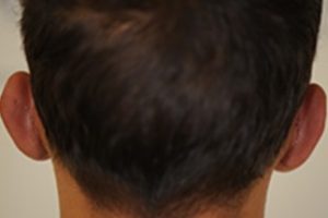 PRP hair loss treatment