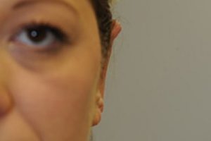 eyelid surgery treatment | Skin and Laser Surgery Center of New England