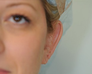 eyelid surgery | Skin and Laser Surgery Center of New England
