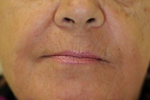 wrinkle reduction after image | Skin and Laser Surgery Center of New England