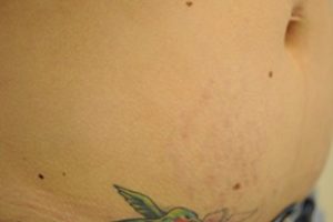 stretch marks after and before | Skin and Laser Surgery Center of New England