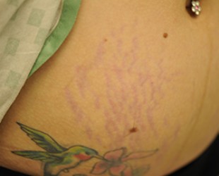stretch marks treatment | Skin and Laser Surgery Center of New England
