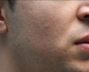 Acne Scars