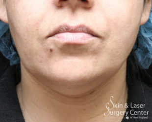 truSculpt fat reduction | Skin and Laser Surgery Center of New England