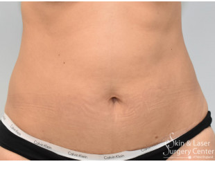 fat removal before and after | Skin and Laser Surgery Center of New England