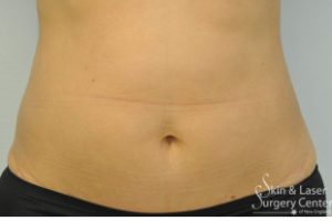 belly fat removal before and after | Skin and Laser Surgery Center of New England