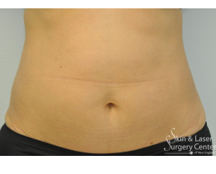 belly fat removal before and after | Skin and Laser Surgery Center of New England