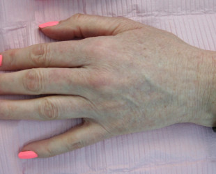 Before & After Brown Spot Removal on hands using Nd:YAG Laser