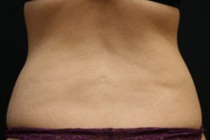 truSculpt fat reduction after and before