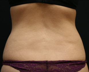 truSculpt fat reduction after and before