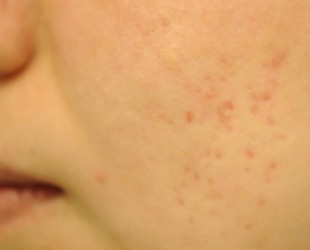 acne treatment | Skin and Laser Surgery Center of New England