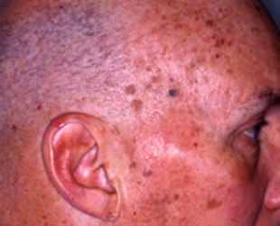 Age Spots / Sun Damage