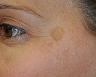 Age Spots / Sun Damage