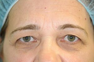 laser blepharoplasty before and after | Skin and Laser Surgery Center of New England