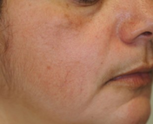 laser hair removal | Skin and Laser Surgery Center of New England