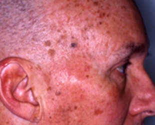 Age Spots and Sun Damage Before and after