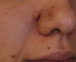 Mole / Growth Removal
