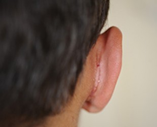 Otoplasty / Protruding Ears