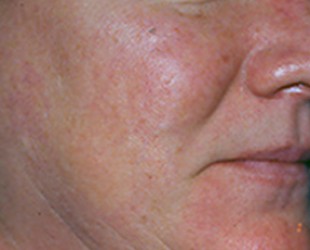 skin resurfacing before and after | Skin and Laser Surgery Center of New England