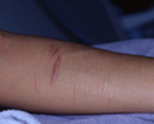 scar treatment image | Skin and Laser Surgery Center of New England