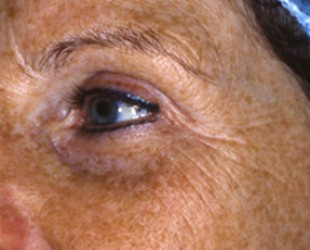 laser treatment for under eye wrinkles | Skin and Laser Surgery Center of New England