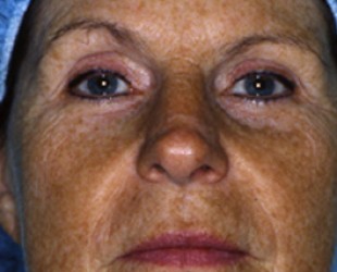 age spot and sun damage before and after image | Skin and Laser Surgery Center of New England