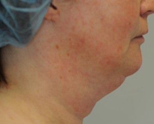 trusculpt treatment | Skin and Laser Surgery Center of New England