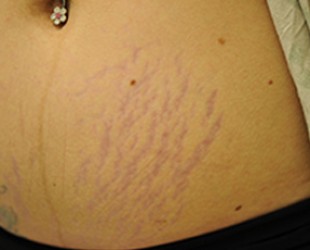 stretch marks | Skin and Laser Surgery Center of New England