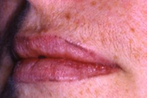 lip filler before and after | Skin and Laser Surgery Center of New England