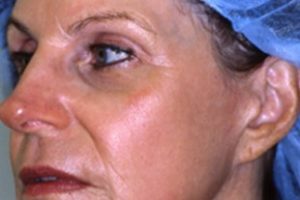 ageless skin rejuvenation after image | Skin and Laser Surgery Center of New England