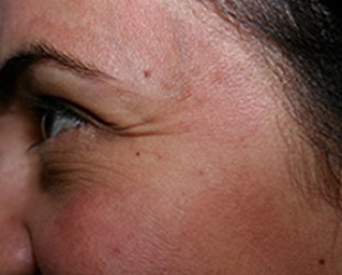 wrinkle laser treatment | Skin and Laser Surgery Center of New England