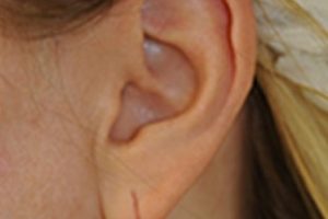 earlobe repair | Skin and Laser Surgery Center of New England