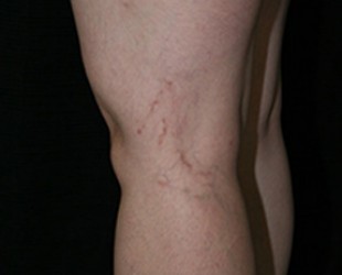 Leg Vein Removal / Sclerotherapy