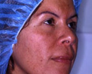 skin rejuvenation treatment | Skin and Laser Surgery Center of New England