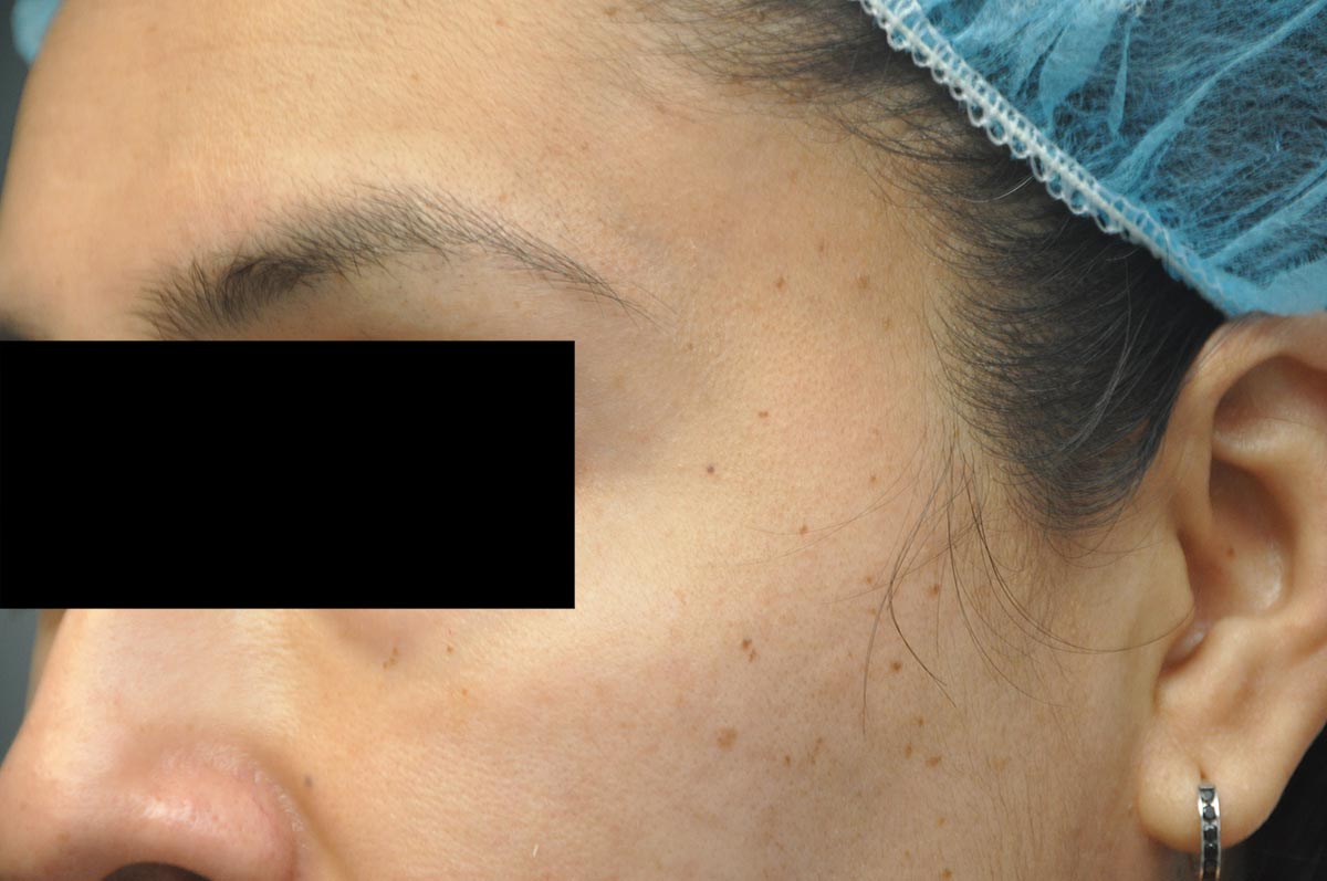 Acne Scars / Melasma