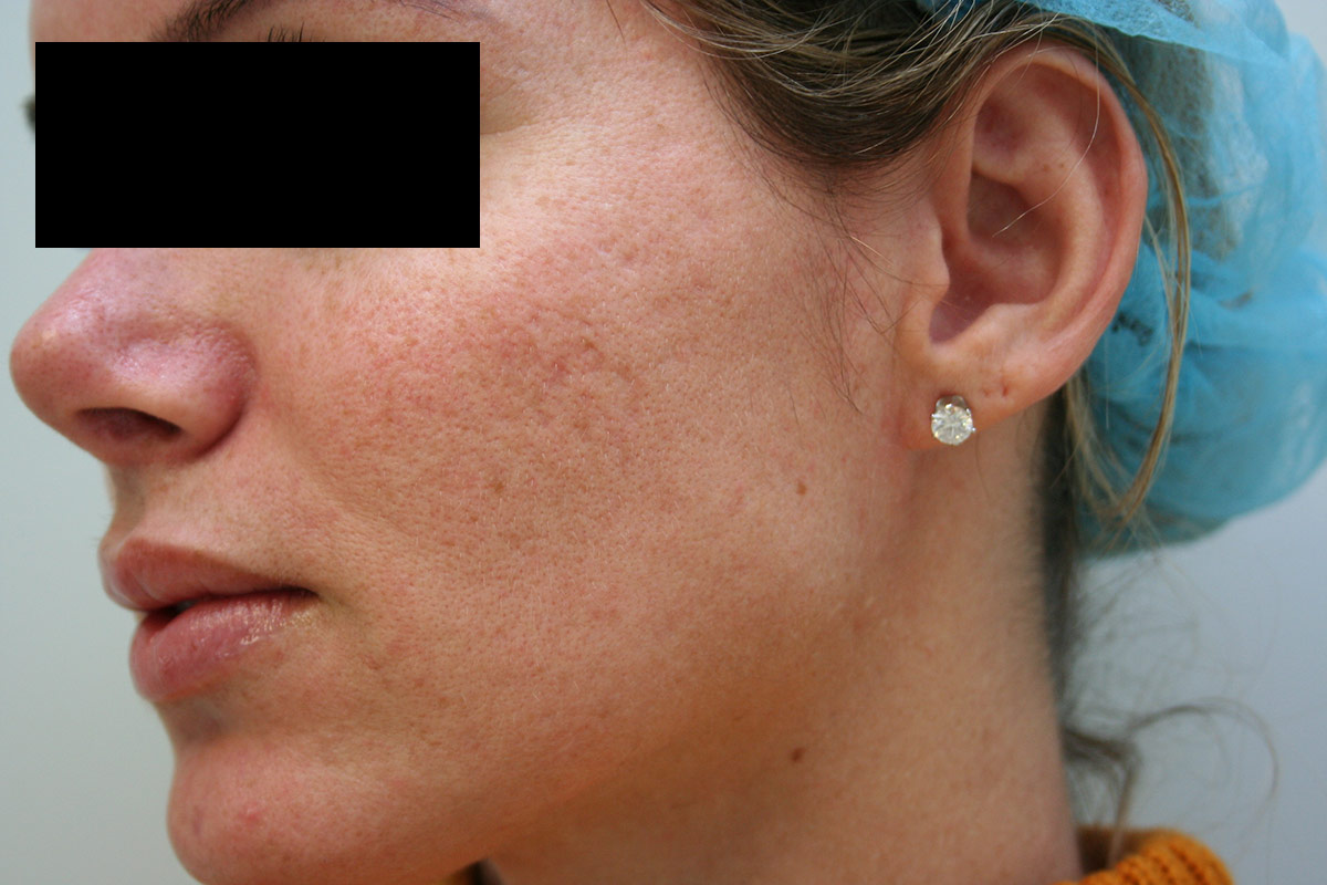 Acne Scars/Pores/Melasma