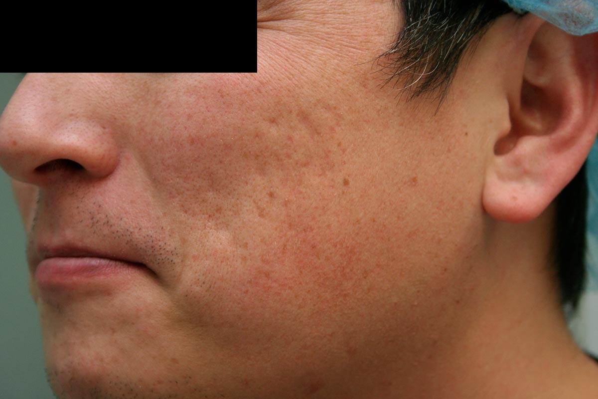 Laser Resurfacing, Acne Scars