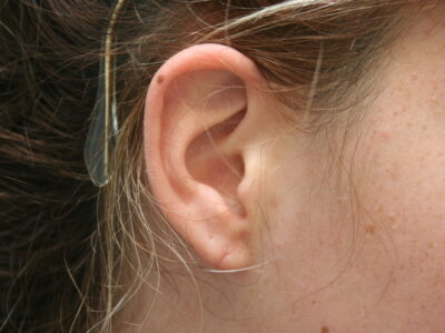 Non Surgical Earlobe Repair and Reduction