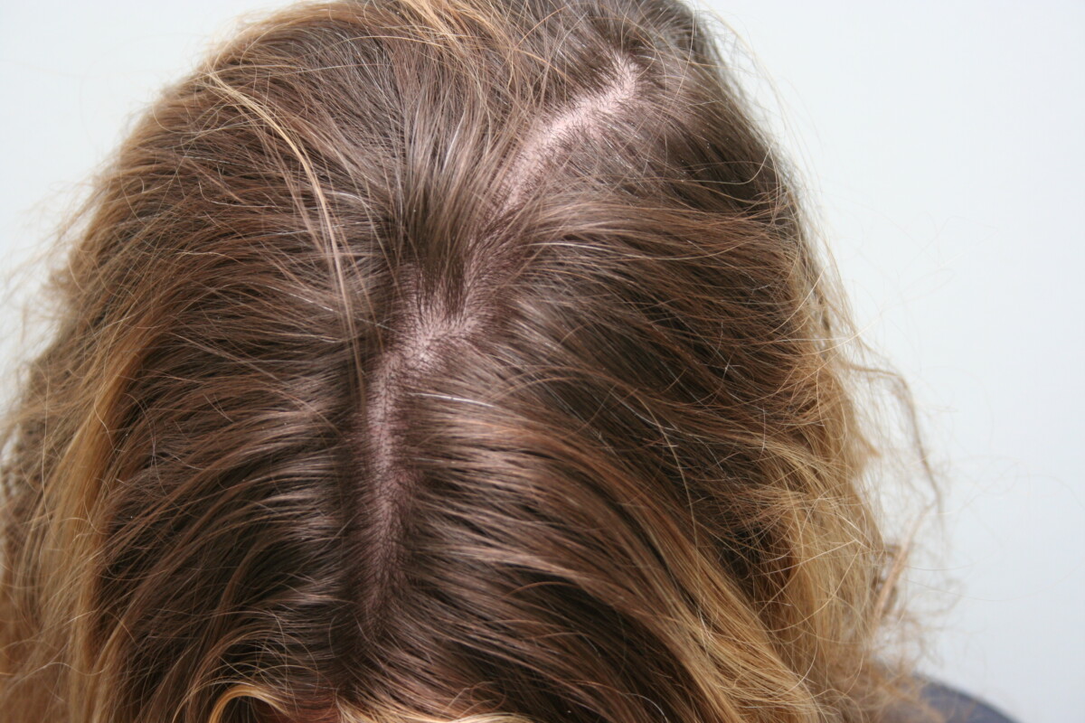 PRP Hair Loss Treatment