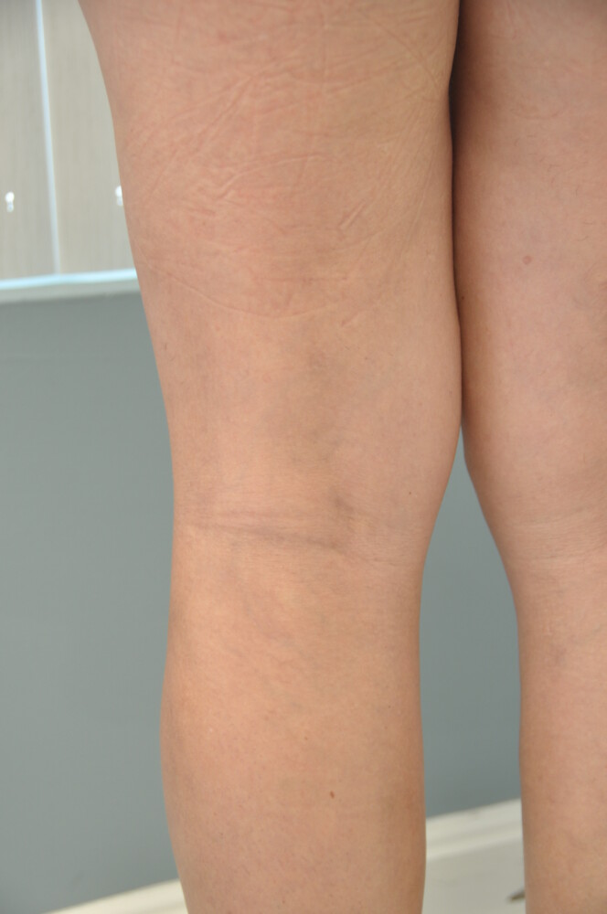Leg Vein Removal / Sclerotherapy