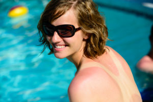 How to Treat Sunburned Skin