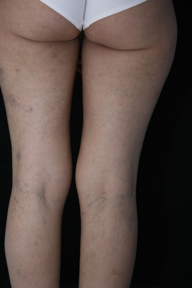 Leg Vein Removal / Sclerotherapy